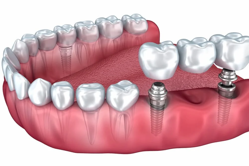 Zahnimplantate, gesammeltes Wissen — Zahn.Arzt.Praxis.Helbig